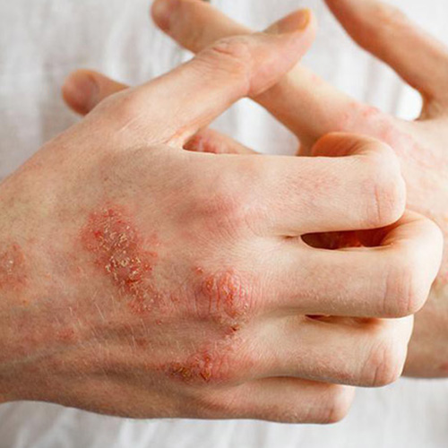 Điều trị chàm Điều trị chàm