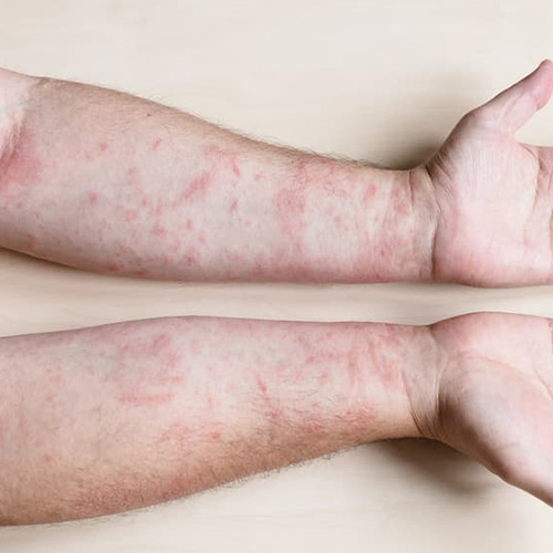 Điều trị viêm da tiếp xúc Điều trị viêm da tiếp xúc