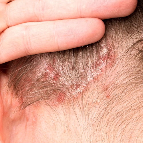 Điều trị Viêm da tiết bã Điều trị Viêm da tiết bã